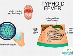 Typhoid Fever Artinya Apa